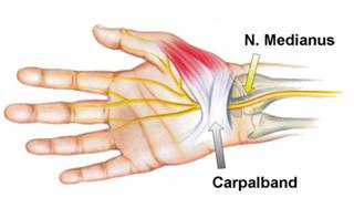 Carpale tunnelsyndroom